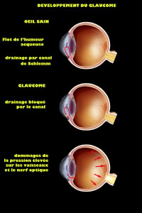 Développement du glaucome