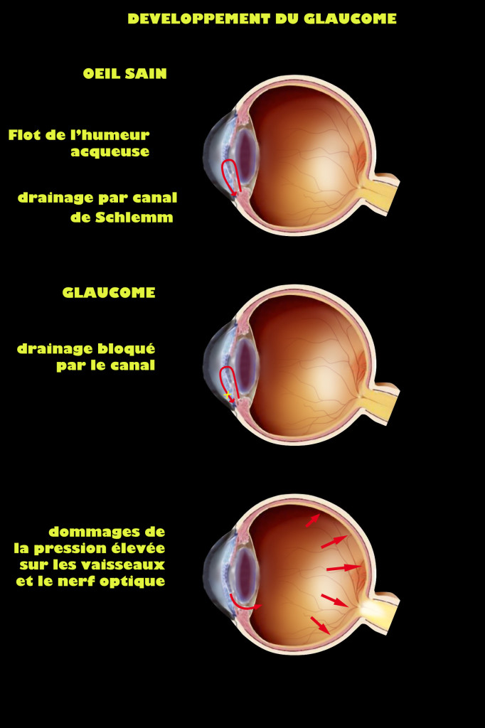 Développement du glaucome