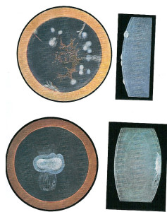 L'opacité du cristallin empêche les rayons lumineux d'atteindre la rétine et elle est donc responsable d'une baisse d'acuité visuelle. Le seul moyen d'améliorer la vision est de pratiquer l'extraction du cristallin. Cette intervention est simple et peut se dérouler en ambulatoire.